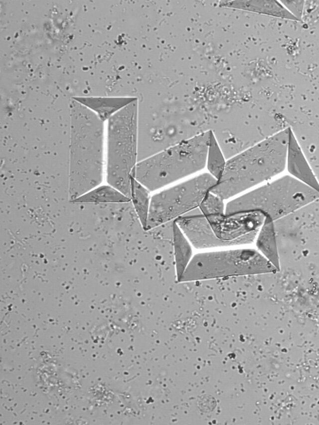 Quick Revision Of Normal Urinary Crystals Clinical Laboratory Guide