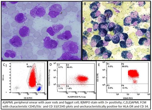 Myeloperoxidase Stain(MPO)-principle ,procedure ,uses